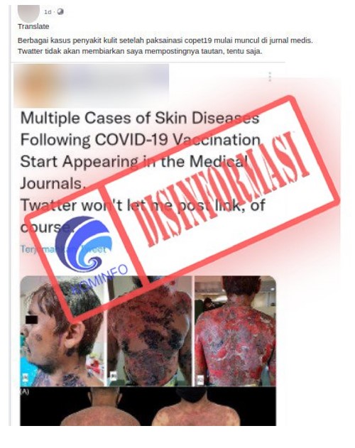 Kangen water psoriasis clearance
